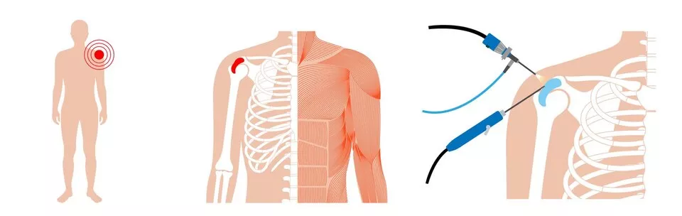 چه زمانی جراحی شانه توصیه می‌شود؟